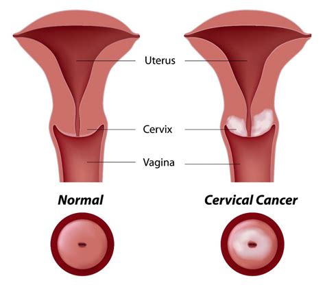 Prominent Cervical Cancer Symptoms Visible in Women - Dr Lal PathLabs Blog