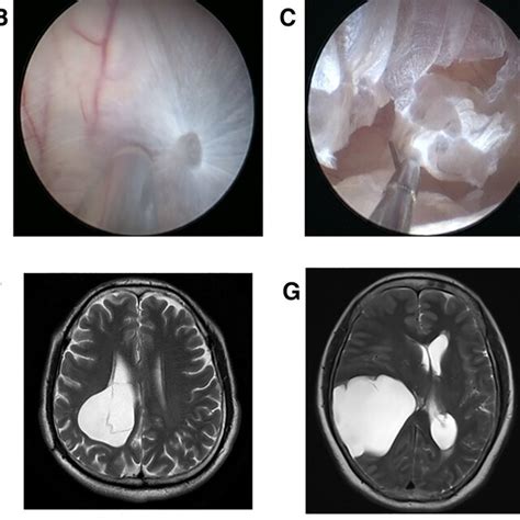 Neuroendoscopic treatment to intracranial arachnoid cyst. (A) Lateral ...