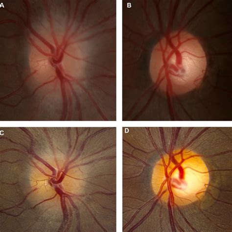 Nonarteritic anterior ischemic optic neuropathy (NAION) in the left eye ...