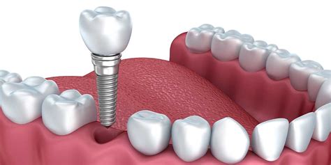 Are All Dental Implants The Same? - Saskatoon Smiles