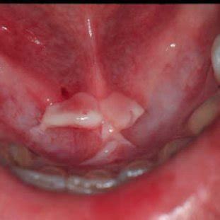 Ulceration on the sublingual caruncula region. | Download Scientific ...