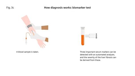 Liver fibrosis: Patients can be at risk of death even without exhibiting symptoms