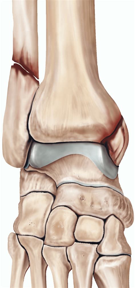 Ankle fracture surgery | healthdirect