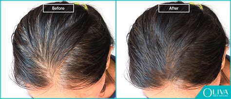 Thyroid Disorder & Hair Loss – How To Regrow Lost Hair?