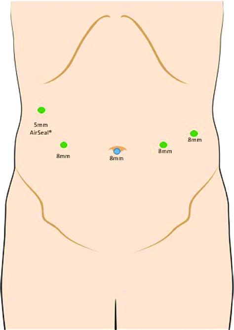 Robotic fundoplication port placement. | Download Scientific Diagram