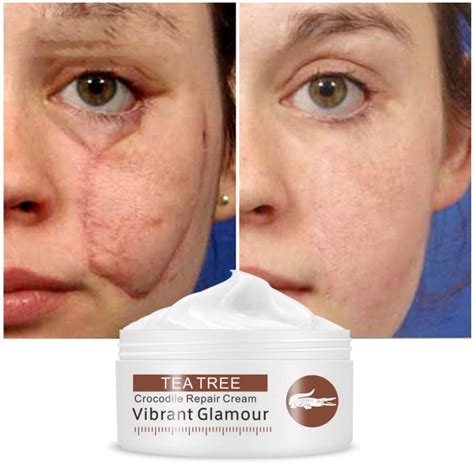 Scar Repair Face Cream Acne Removal Whitening Acne Treatment Stretch Marks Skin Care Cream new ...