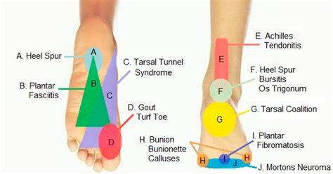 Heel Pain Diagnosis Chart - Best Picture Of Chart Anyimage.Org