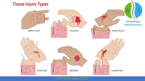 Soft Tissue Injury | OrthoFixar 2024