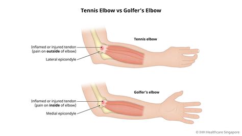 Symptoms & Causes - Tennis Elbow