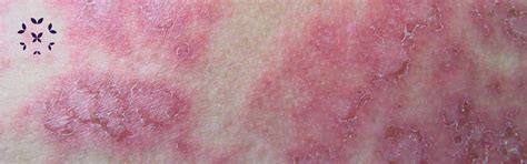 Cutaneous Lupus - Kaleidoscope Fighting Lupus