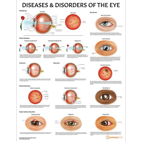 Rare Genetic Eye Diseases