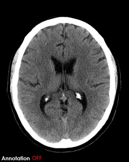 Normal Brain Ct Anatomy