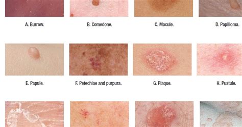 Medical Addicts: Terms used to describe skin lesions