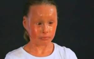 Harlequin Ichthyosis – Pictures, Survivors, Causes, Treatment