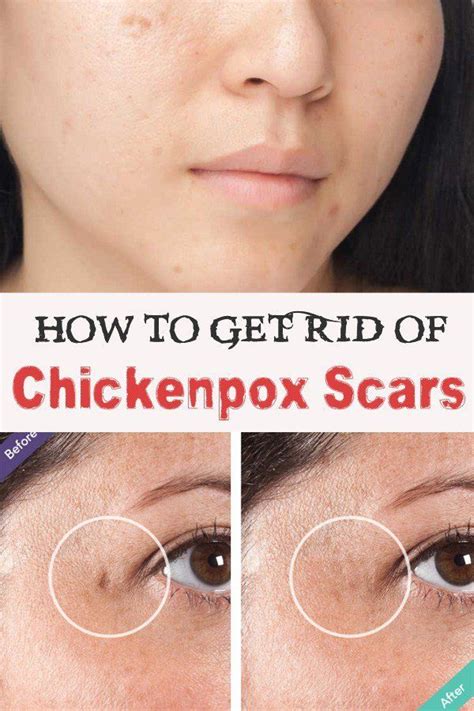 Old Chicken Pox Scars Removal - Draw-humdinger