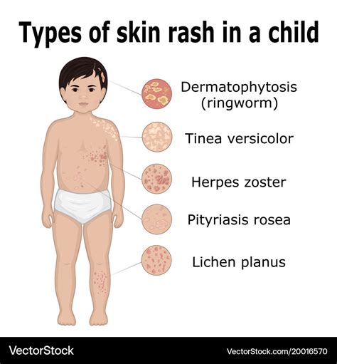 Types of skin rash in a child Royalty Free Vector Image