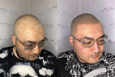 Toshi Before After 2 - FULL Micropigmentation