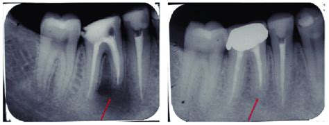 Periapical X Ray