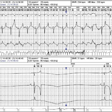 A section of Base-Apex lead ECG signal obtained from holter ECG ...