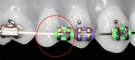 Orthodontics Australia | What to Do If Your Braces Are Broken