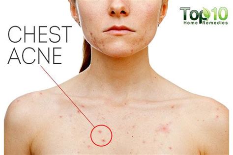 Home Remedies to Get Rid of Chest Acne | Top 10 Home Remedies