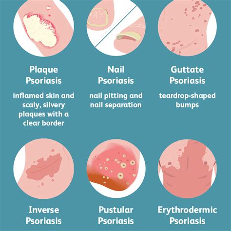 Psoriasis | Chronic Skin Disease | Seattle Dermatology