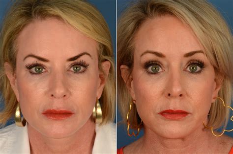 Eyebrow & Forehead Photos | Naples, FL | Patient 16700