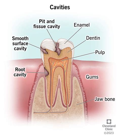 Is a cavity a hole? – Fabalabse