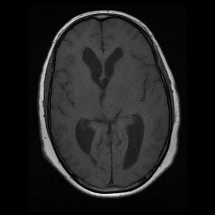 Petroclival meningioma | Radiology Case | Radiopaedia.org