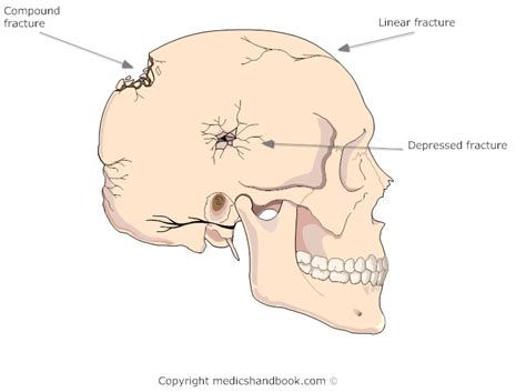 Types Of Skull Fracture - Fracture Treatment