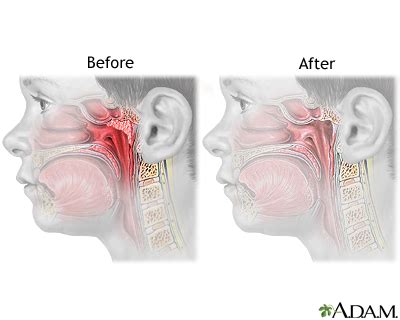 Adenoid removal - series—Aftercare: MedlinePlus Medical Encyclopedia