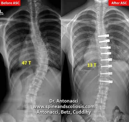 Before and After Scoliosis Surgery Case Studies