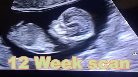 12 Week Ultrasound Pictures Gender