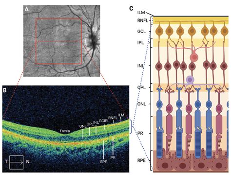 MS Minute: Retinal Optical Coherence Tomography for MS - Practical Neurology