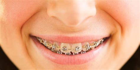 How To Manage Pain And Discomfort From Broken Braces - Dentist Olds Alberta - General & Family ...