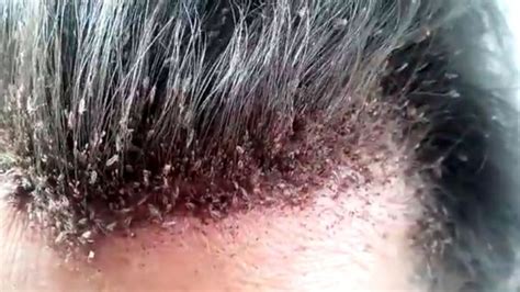 Head lice infestation - Symptoms, causes and risk factors