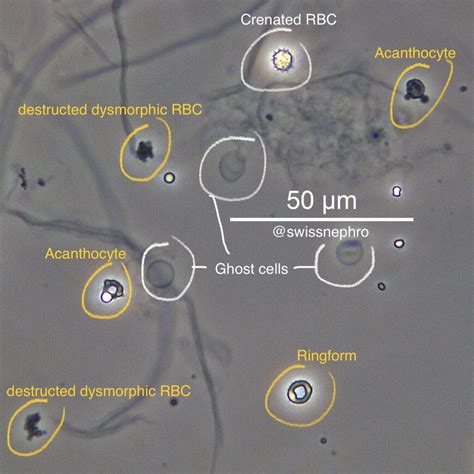 Urine Microscopy – GlomCon (pubs)