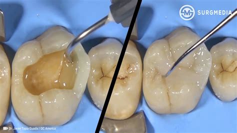 Step by Step Dental Filling (Cavity Filling - Tooth Filling): Cusp Build-Up of a Molar - YouTube