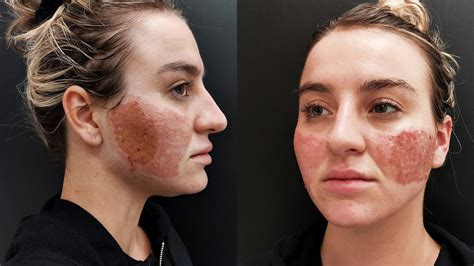 Acne Scar Removal with CO2 Laser Treatment - Before & After - Oasis Medical Aesthetics