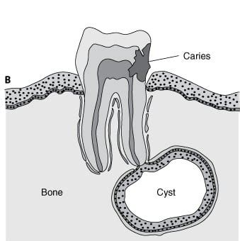 Periapical Cyst Histology