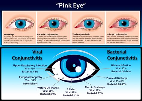 Pin on Eye Health Tips