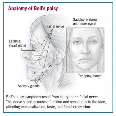 Facial palsy causes – Telegraph