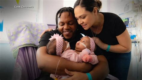 Conjoined twins Texas: 3-month-old sisters successfully separated after 11-hour surgery at Cook ...