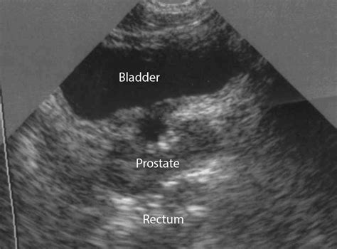 Normal Bladder Ultrasound