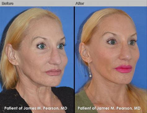 Mid Face Lift / Cheek Lift - Dr. James Pearson Facial Plastic Surgery