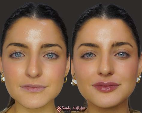 Lip Filler Before & After Results - Skinly Aesthetics