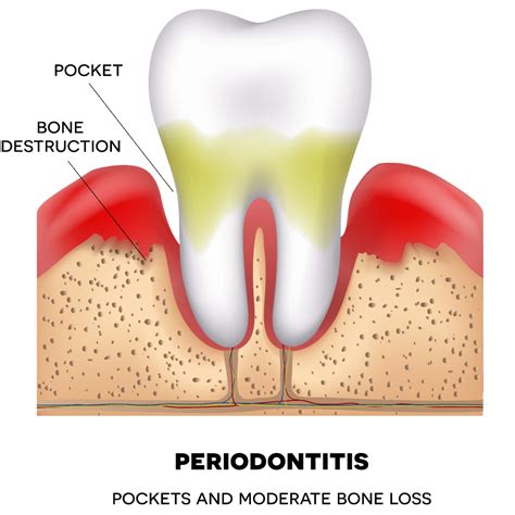 10 Important points about Periodontal Pocketing