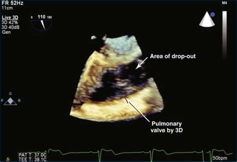 Pulmonary Valve in Health and Disease - Clinical Tree