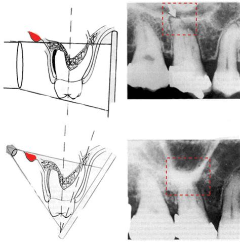 Periapical X Ray Techniques - Radiographs In The Diagnosis Of ...