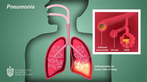 Pneumonia - St Vincent's Lung Health